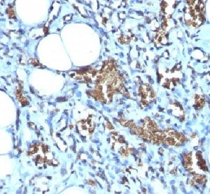 IHC-P: Formalin-fixed, paraffin-embedded human angiosarcoma stained with Glycophorin A antibody (clo
