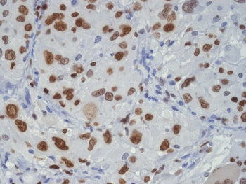 IHC staining of FFPE human glioma tissue with TAR DNA binding protein 43 antibody, HRP-secondary and