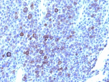 IHC: Formalin-fixed, paraffin-embedded human melanoma stained with Glypican-3 antibody (1G12 + GPC3/