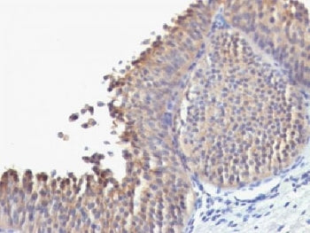 IHC testing of FFPE human bladder carcinoma with Cytokeratin 10 antibody (clone SPM623). Required HI