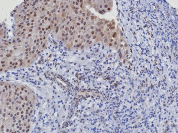 IHC staining of FFPE human bladder cancer tissue with recombinant CDK4 antibody (clone CDK4/8351R). 