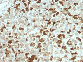 IHC testing of FFPE human melanoma tissue with recombinant NGFR antibody. Required HIER: boil tissue