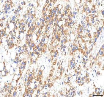 IHC staining of FFPE human liver cancer tissue with OMI antibody. HIER: boil tissue sections in pH8 