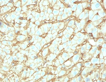 IHC testing of FFPE human hepatocellular carcinoma with Albumin antibody (clone ABMN-1). Required HI