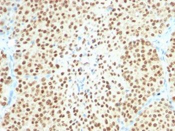 IHC testing of FFPE melanoma with recombinant SOX10 antibody (clone SOX10/2311R). Required HIER: boi