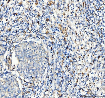 IHC staining of FFPE human lung cancer tissue with CD163 antibody. HIER: boil tissue sections in pH8