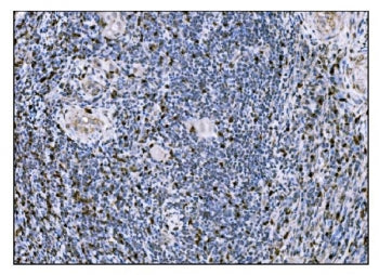 IHC staining of FFPE human gallbladder adenocarcinoma tissue with FosB antibody. HIER: boil tissue s