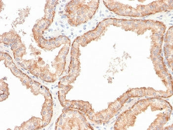 IHC staining of FFPE human prostate carcinoma with recombinant IL-10 antibody (clone IL10/2651R). HI