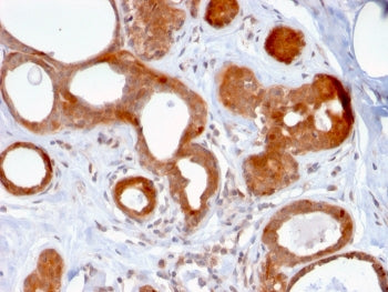IHC staining of FFPE human breast carcinoma with ZNF690 antibody (clone ZSCAN29/2610). HIER: boil ti