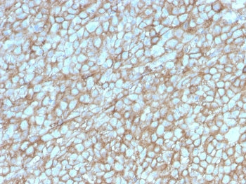 IHC staining of FFPE human melanoma with MCAM antibody. HIER: boil tissue sections in pH 9 10mM Tris