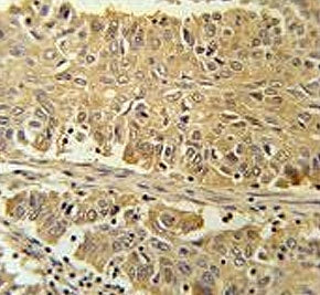 IHC testing of FFPE human lung carcinoma tissue with PGD antibody. HIER: steam section in pH6 citrat