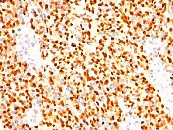 IHC: Formalin-fixed, paraffin-embedded human rhabdomyosarcoma stained with anti-Myogenin antibody (c