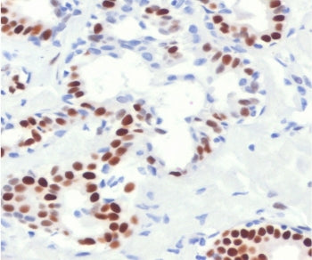 IHC staining of FFPE human breast cancer with Estrogen Receptor alpha antibody (clone NR3Ga-4R). Req