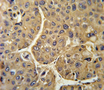 IHC testing of FFPE human hepatocellular carcinoma tissue with FHR-5 antibody. HIER: steam section i