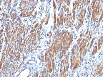 IHC: Formalin-fixed, paraffin-embedded human Leiomyosarcoma stained with SM-MHC antibody (clone SMMS