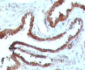 IHC testing of FFPE human prostate carcinoma and HSP27 antibody (clone SRPR27). Staining of formalin