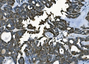 IHC staining of FFPE human ovarian cancer with PORC-PI-1 antibody. HIER: boil tissue sections in pH8