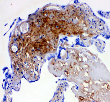 IHC-P: Decorin antibody testing of human breast cancer tissue. HIER: boil tissue sections in pH6, 10