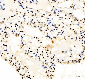 IHC staining of FFPE human renal cell carcinoma tissue with JUND antibody. HIER: boil tissue section