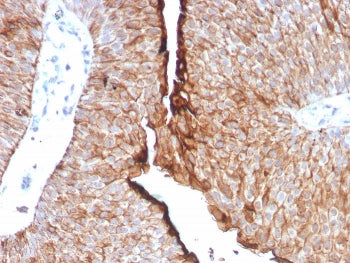 IHC staining of FFPE human urothelial carcinoma tissue with UPK1B antibody (clone UPK1B/8976R). HIER