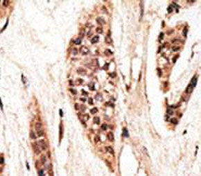 IHC analysis of FFPE human breast carcinoma tissue stained with the TAP1 antibody