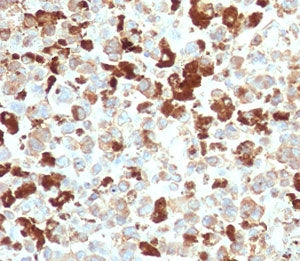 IHC testing of FFPE human melanoma with recombinant NGFR antibody (clone CDLA271-2R). Required HIER: