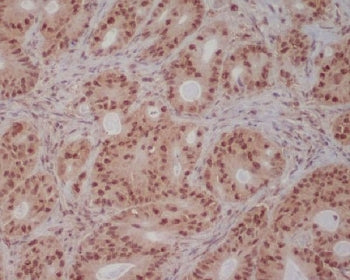 IHC staining of FFPE human colon cancer with PIK3R2 antibody. HIER: boil tissue sections in pH6, 10m