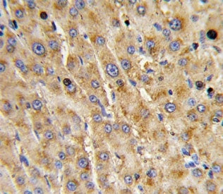 IHC analysis of FFPE human hepatocarcinoma with ADAMTS13 antibody