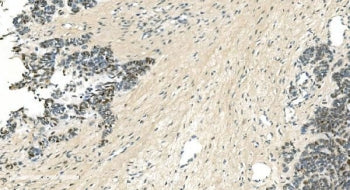 IHC staining of FFPE human ovarian cancer with LSM5 antibody. HIER: boil tissue sections in pH8 EDTA