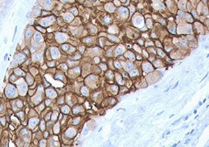 IHC staining of FFPE human breast cancer with HER2 antibody (clone 2KRI7-3). HIER: boil tissue secti