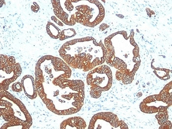 IHC analysis of formalin-fixed, paraffin-embedded human colon carcinoma stained with Cytokeratin 18 