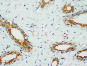 IHC staining of FFPE human breast cancer with PP2Ac antibody. HIER: boil tissue sections in pH8 EDTA