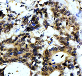 IHC staining of FFPE human colon cancer tissue with Alpha-Synuclein antibody, HRP-secondary and DAB 