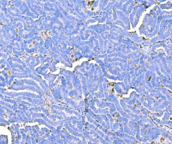 IHC staining of FFPE human ovarian cancer tissue with Prothrombin antibody. HIER: boil tissue sectio