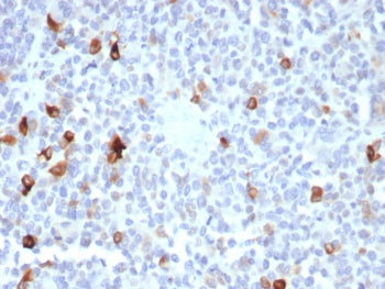 IHC staining of FFPE human melanoma tissue with Melan-A antibody (clone MLANA/8365R). HIER: boil tis