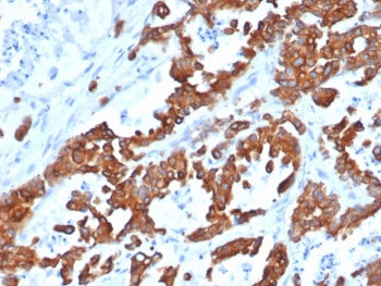 IHC testing of FFPE human prostate carcinoma and recombinant EpCAM antibody (clone EGP40/1555R). HIE