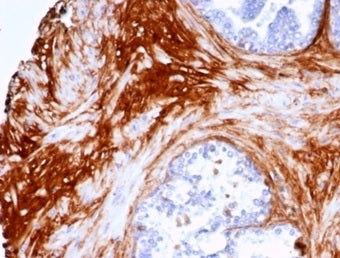 IHC staining of FFPE human prostate carcinoma tissue with DCN antibody (clone DCN/7031R). HIER: boil