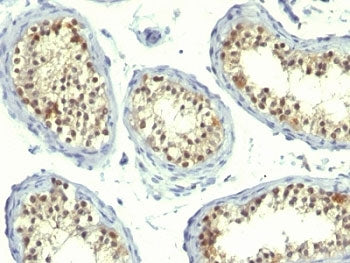IHC: Formalin-fixed, paraffin-embedded human testicular carcinoma stained with Thymidylate Synthase 