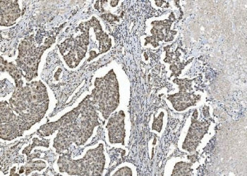 IHC staining of FFPE human breast cancer with HDAC5 antibody. HIER: boil tissue sections in pH8 EDTA