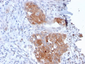 IHC testing of FFPE human bladder carcinoma with Desmoglein 1 antibody (clone 32-2B). HIER: boil tis