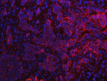 Immunofluorescent staining of FFPE human lung cancer tissue with S100A10 antibody (red) and DAPI nuc