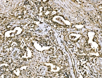 IHC staining of FFPE human stomach cancer tissue with WAPL antibody. HIER: boil tissue sections in p