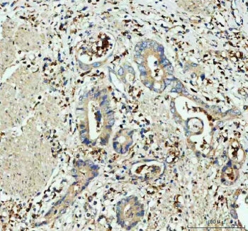 IHC staining of FFPE human colorectal adenocarcinoma tissue with GPX1 antibody. HIER: boil tissue se