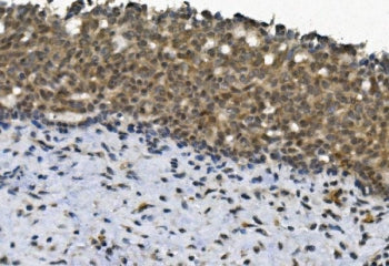 IHC staining of FFPE human breast cancer with EYA4 antibody. HIER: boil tissue sections in pH8 EDTA 