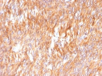 IHC testing of FFPE human small intestine carcinoma with Calnexin antibody. HIER: boil tissue sectio