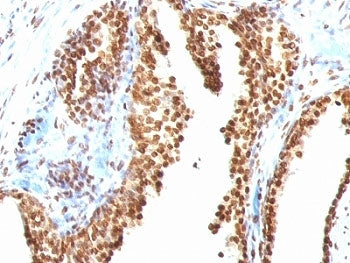 IHC staining of FFPE human colon carcinoma with dsDNA antibody (clone AE-2). HIER: boil tissue secti