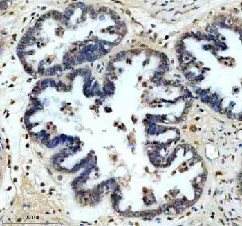 Immunohistochemical staining of SRA1 using anti-SRA1 antibody. SRA1 was detected in a paraffin-embed
