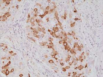 IHC staining of FFPE human lung cancer tissue with recombinant Surfactant protein A antibody at 1:10