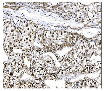 IHC staining of FFPE human liver cancer tissue with EHMT2 antibody. HIER: boil tissue sections in pH