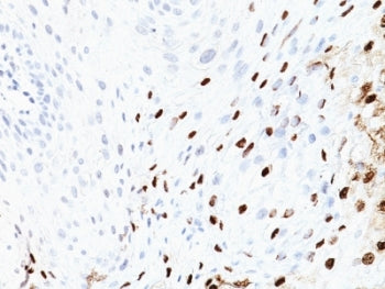 IHC: Formalin-fixed, paraffin-embedded human cervix stained with HPV-16 antibody (SPM405)